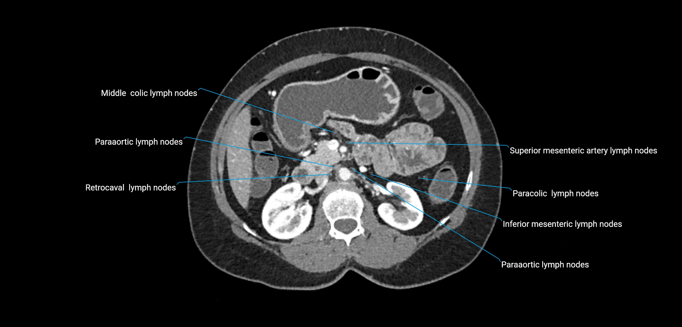 CT ct abdominal lymph nodes  axial cross sectional anatomy  enchanced radiology image -img-00002-00180.webp